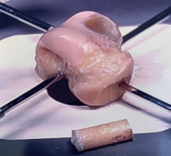 Donor allograft talus with OATs plug removed