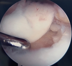 Arthroscopic view of large talar chondral lesion