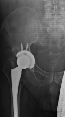 Total Hip Replacement of Ball and Socket