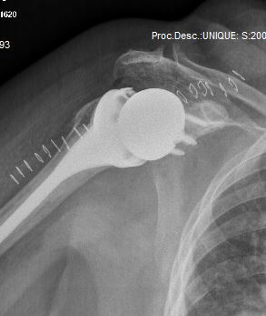 Reverse Total Shoulder Replacement