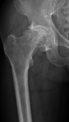 Acute Collapse of Femoral Neck of Hip
