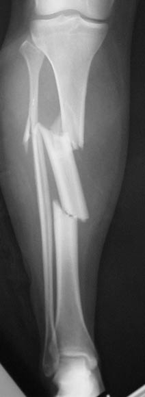 Segmental Tibial Shaft Fracture