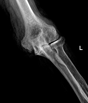 end stage osteoarthritis of the elbow1