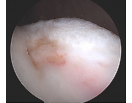 Arthroscopic View Of Large Trochlear Chondral Lesion