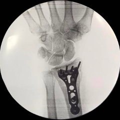 Repair of Distal Radius Fracture Lateral View