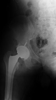 Total Hip Replacement of Ball and Socket