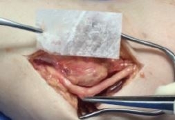 Amnion for Ulnar Nerve Tranposition