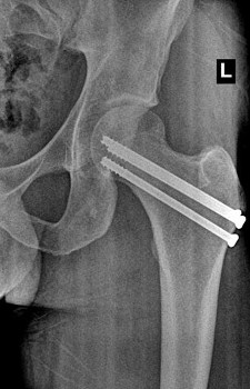 Repair of Femoral Neck Fracture With Screws