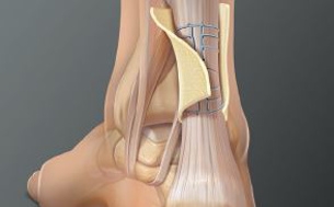 ArthroFLEX in Achilles