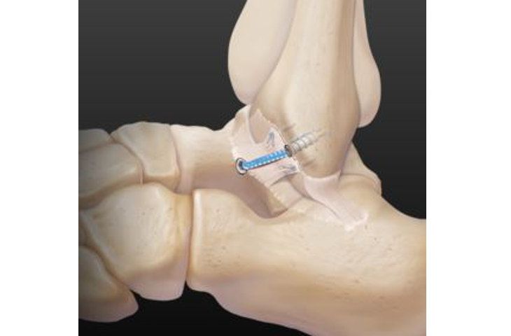 ankle with internal brace