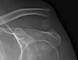 Grade 5 AC separation equivalent with distal clavicle fracture
