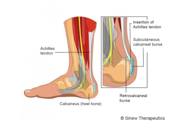 Hey spur and Haglunds deformity-preop | Haglunds deformity, Ankle surgery,  Achilles pain