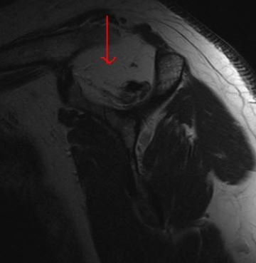 Fatty Infiltration of Supraspinatus