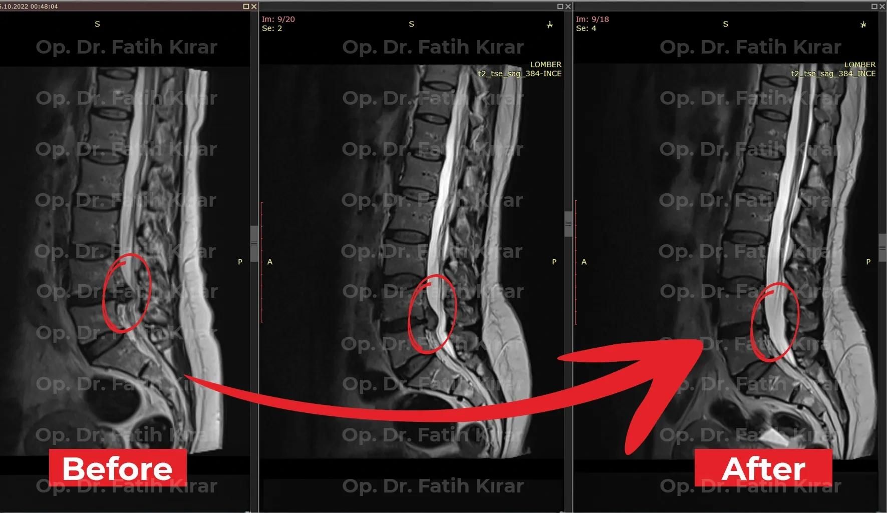 Lumbar spine MRI before and after treatment showing reduced disc herniation and nerve compression, evaluated by Op. Dr. Fatih Kırar at DRFK private hospital in Dubai