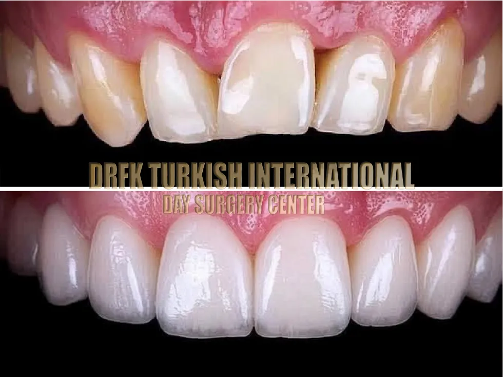 DRFK Digital Smile Design Dubai preview before veneers
