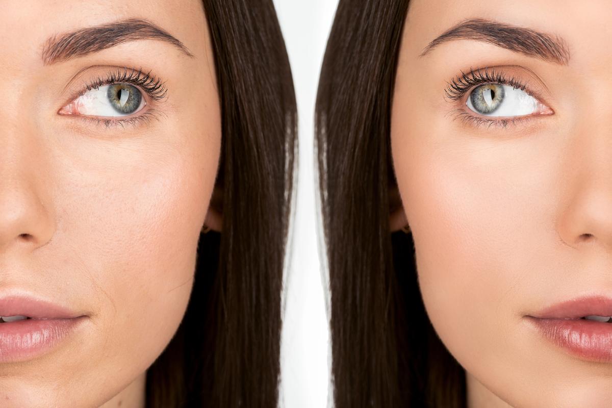 Sculptra before and after results demonstrating natural facial volume improvement through collagen stimulation in a licensed medical center in Dubai
