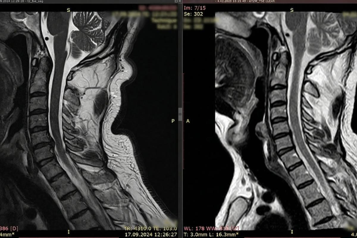 مقارنة لصور الرنين المغناطيسي لفقرات الرقبة تظهر نتائج علاج ديسك الرقبة في أفضل مركز لعلاج العمود الفقري في دبي، مركز DRFK