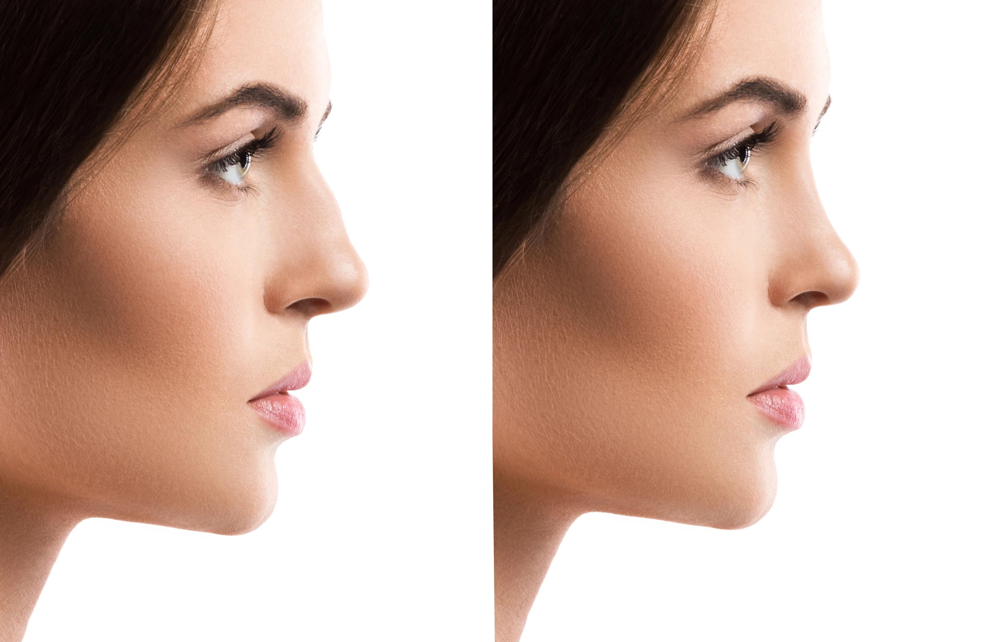 Rhinoplasty before and after results at DRFK private hospital Dubai demonstrating natural nose reshaping and preserved facial identity