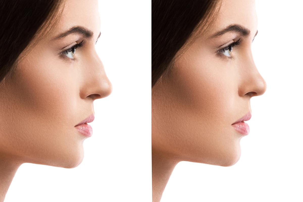 Rhinoplasty before and after results at DRFK private hospital Dubai demonstrating natural nose reshaping and preserved facial identity