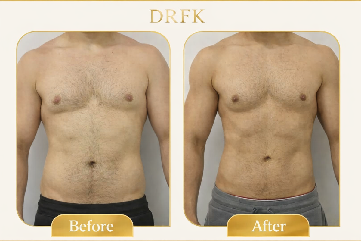 Best liposuction results in Dubai before and after male abdomen contouring at DRFK 