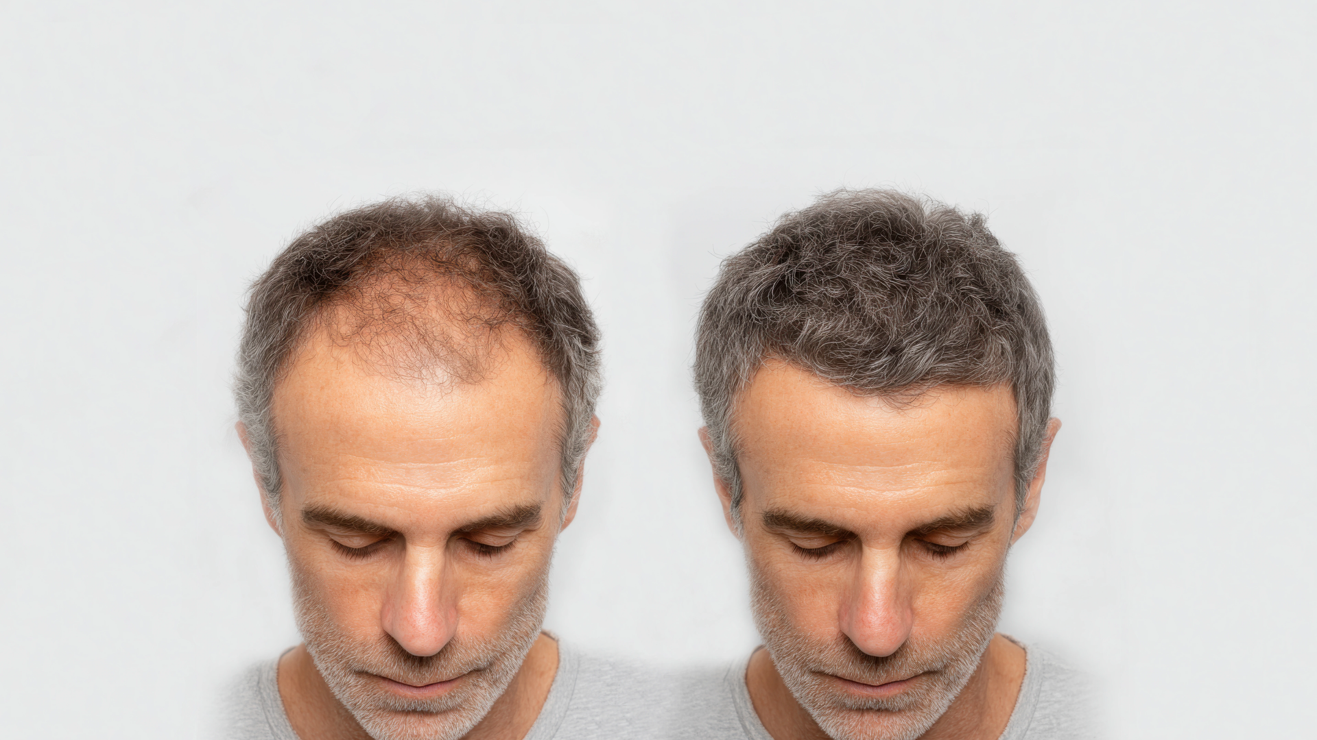 Turkish Private Clinic for Hair Transplant in Dubai | DRFK