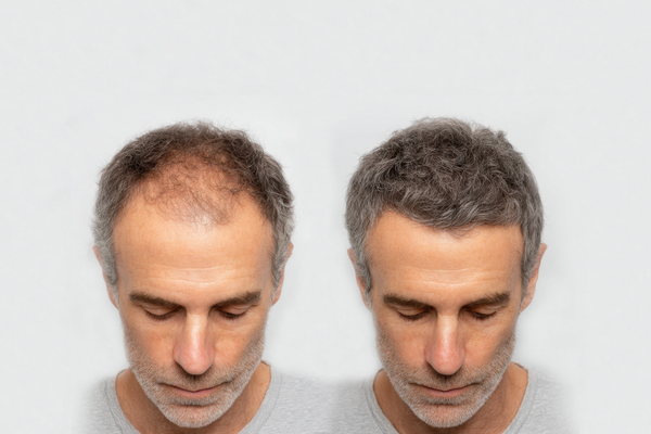 Turkish Private Clinic for Hair Transplant in Dubai | DRFK