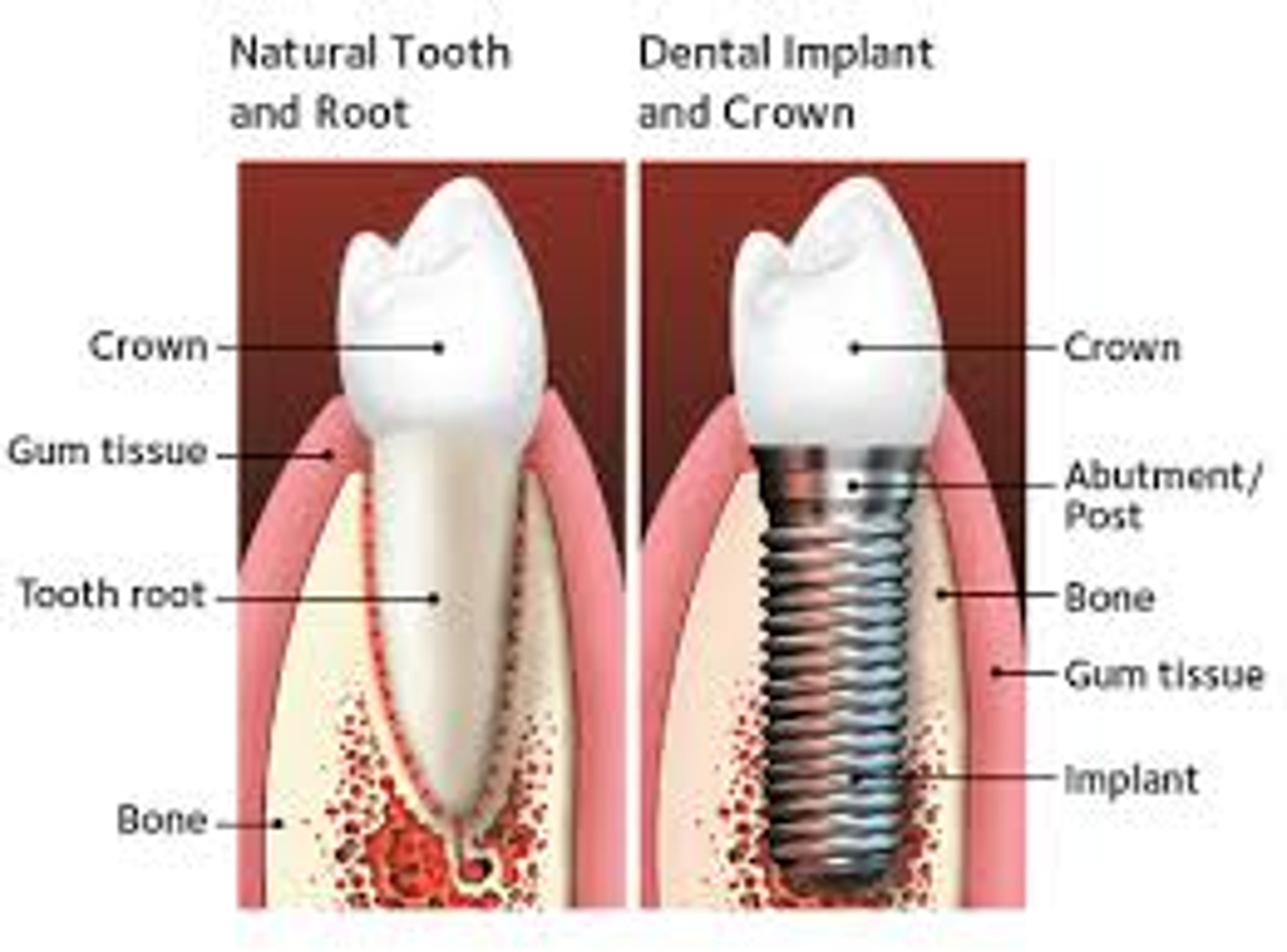 implant