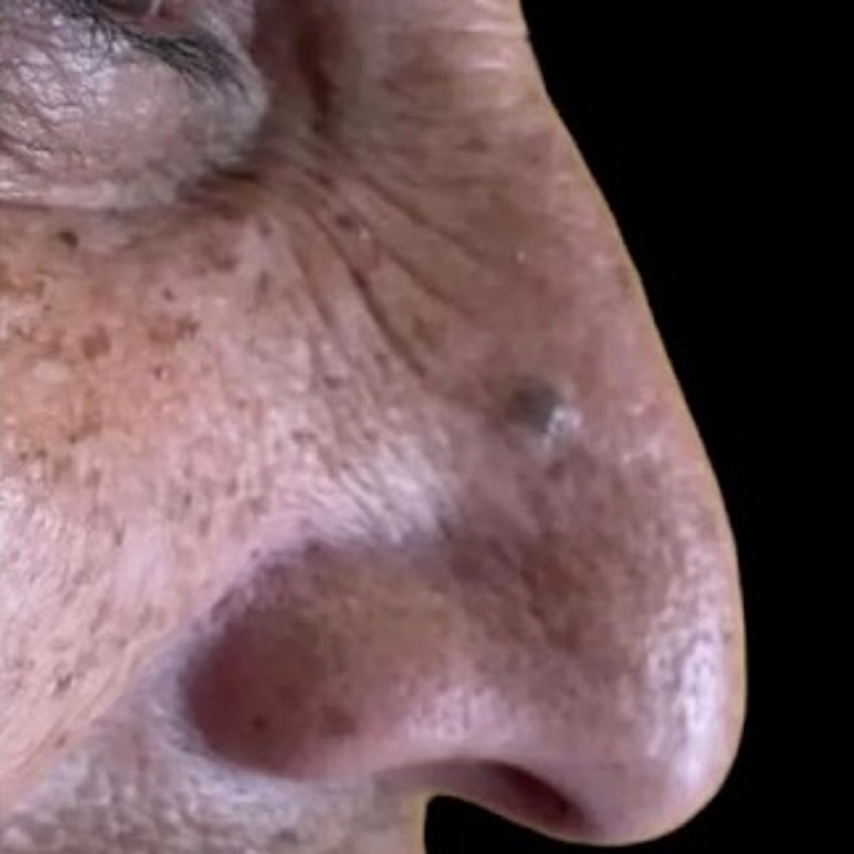 Antes - Rinomodelación