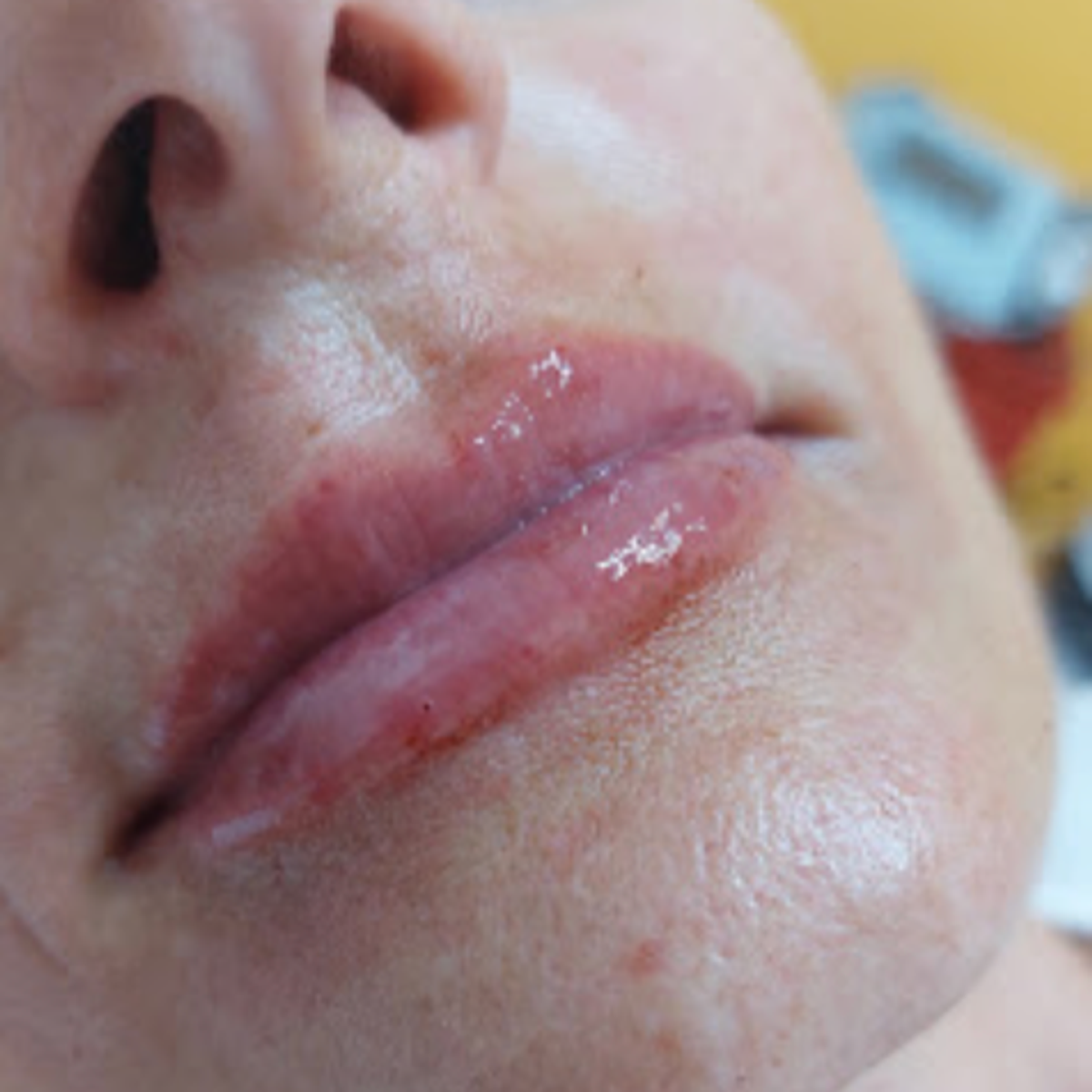 Despues - Modelado de labios