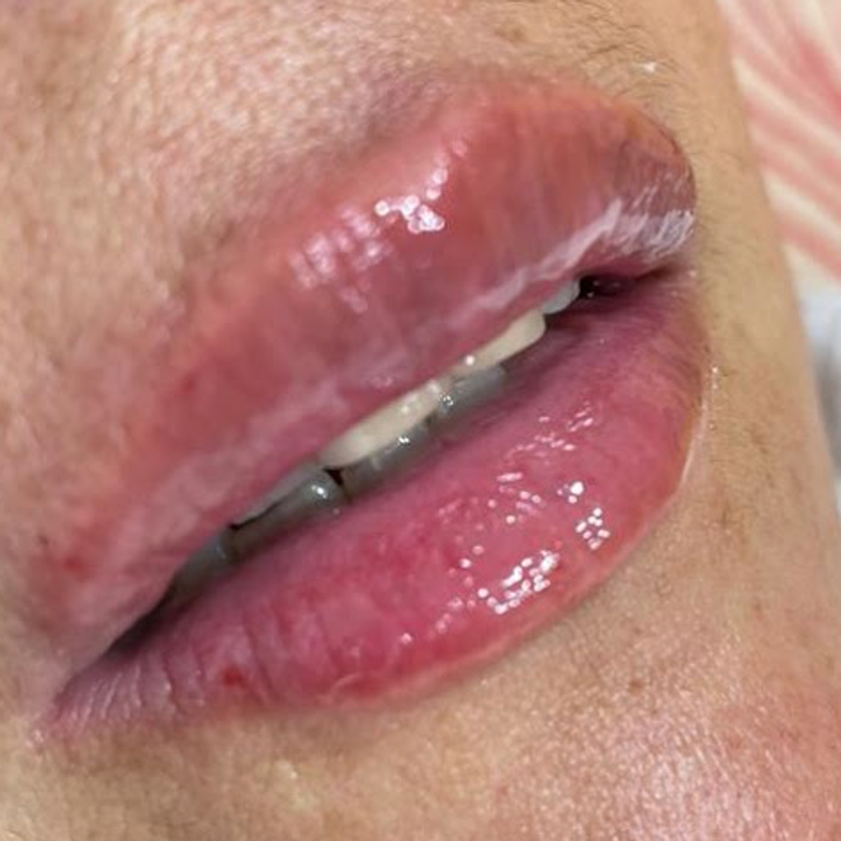 Despues - Modelado de labios 