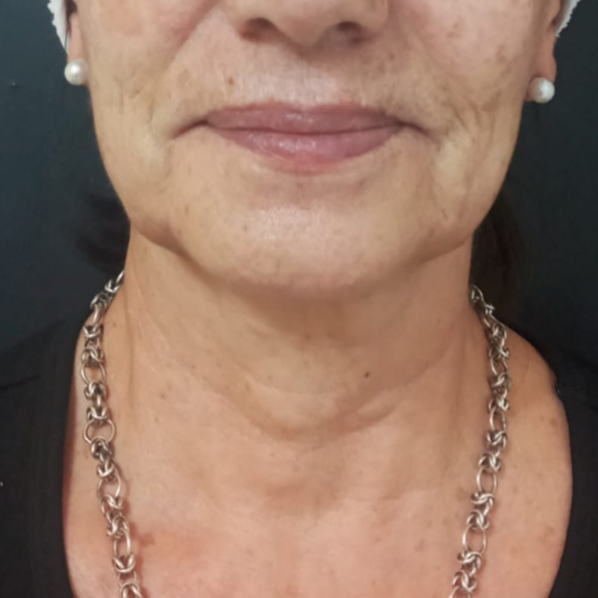 Antes - Armoniación facial 