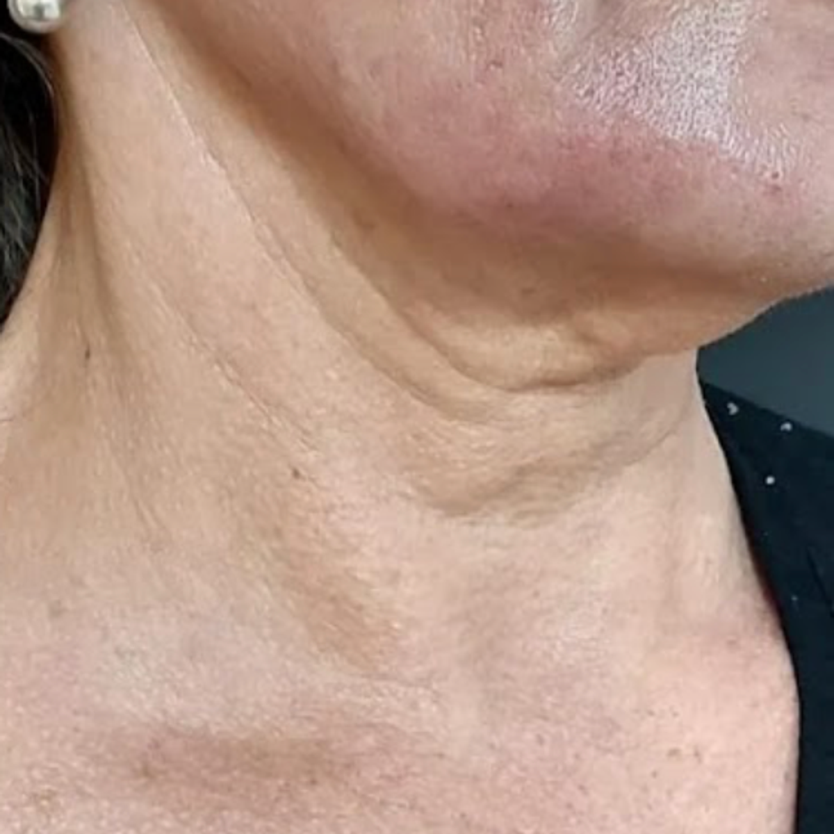 Antes - Armonización facial