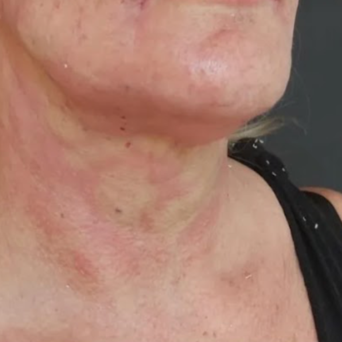 Despues - Armonización facial