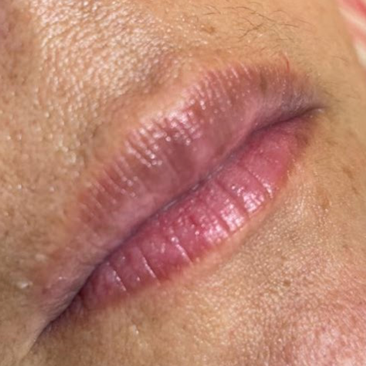 Antes - Modelado de labios 