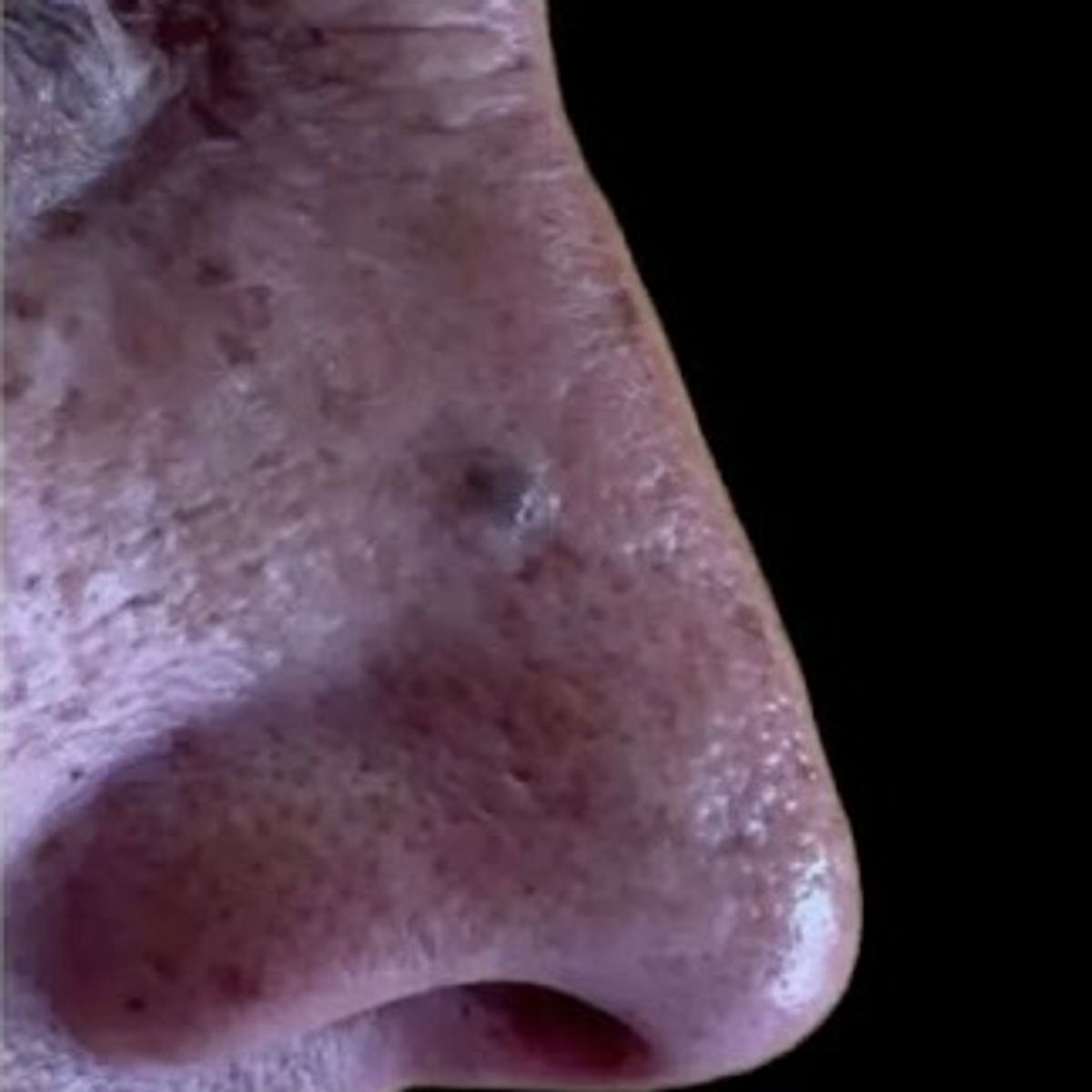 Despues - Rinomodelación