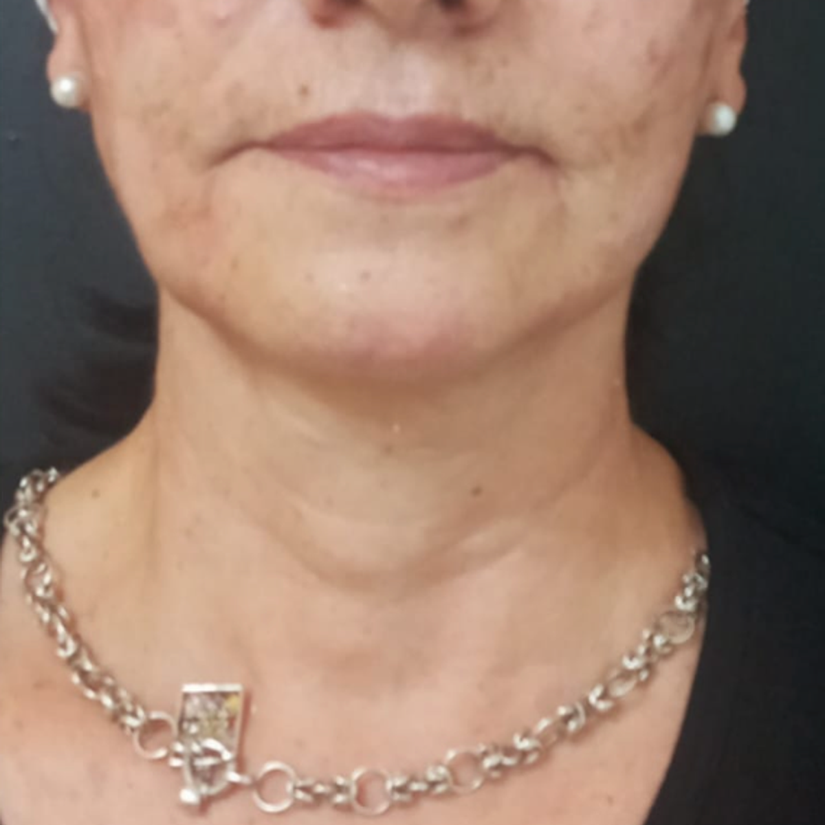 Despues - Armoniación facial 