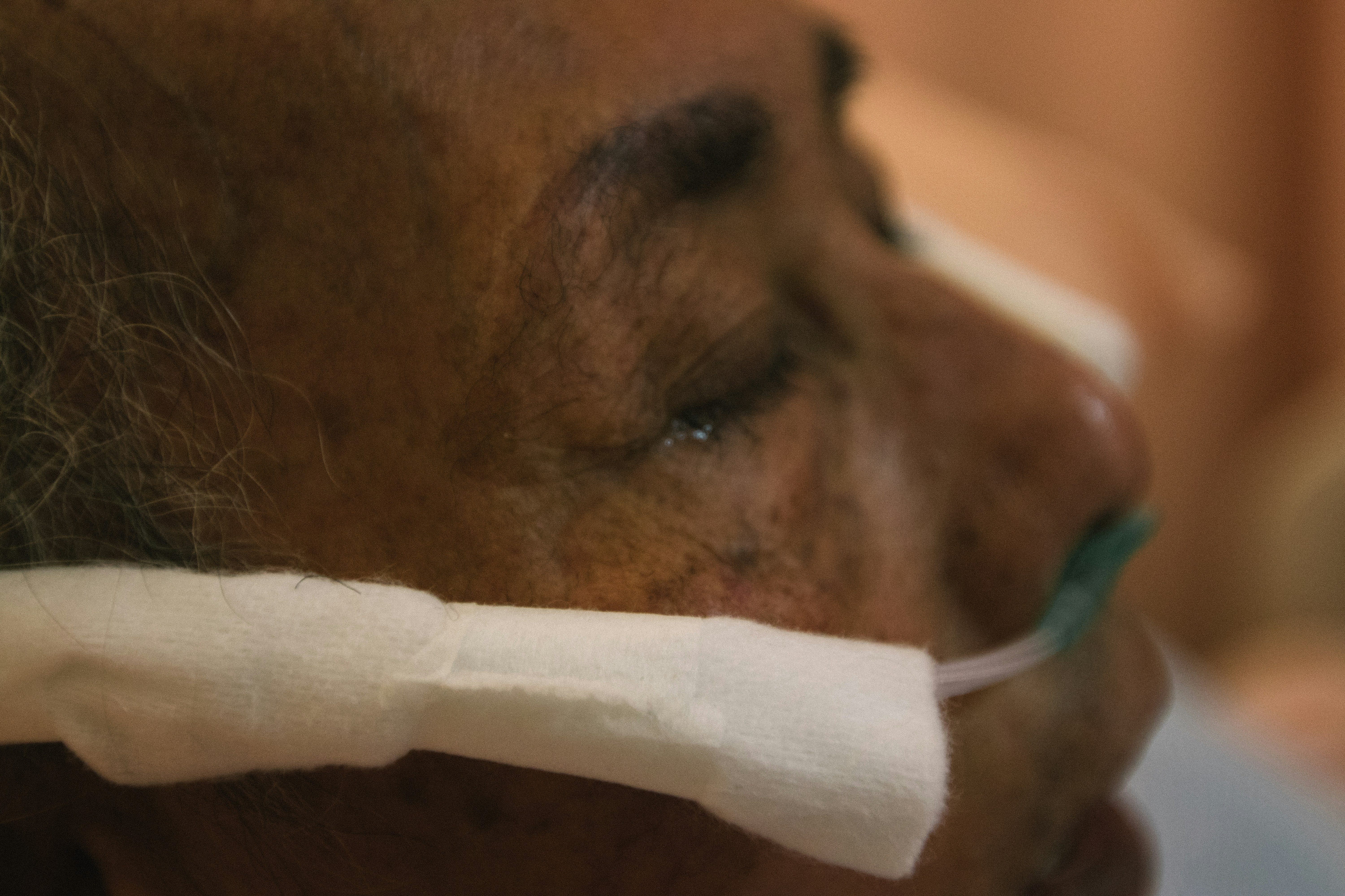 Image Patient receiving medical care with a nasal tube, showing how language barriers and medical errors can lead to serious harm in Texas.