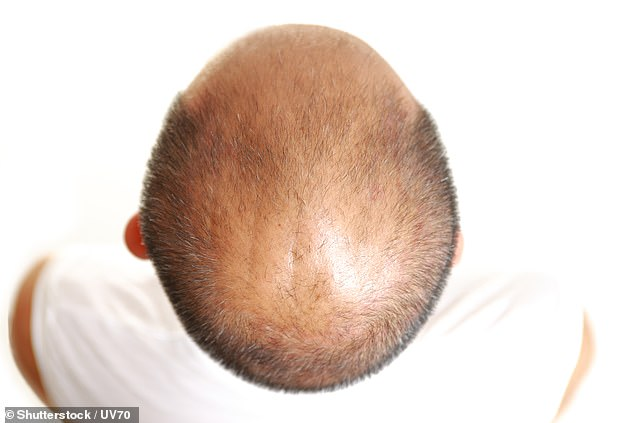 Man's head hair loss