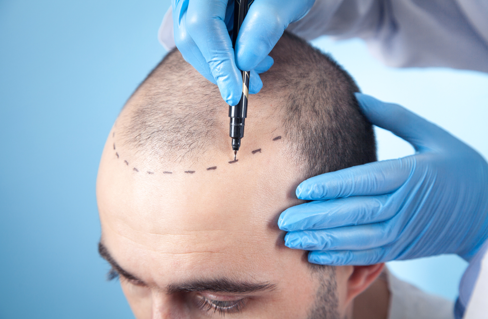 Man scalp marking for tattoo