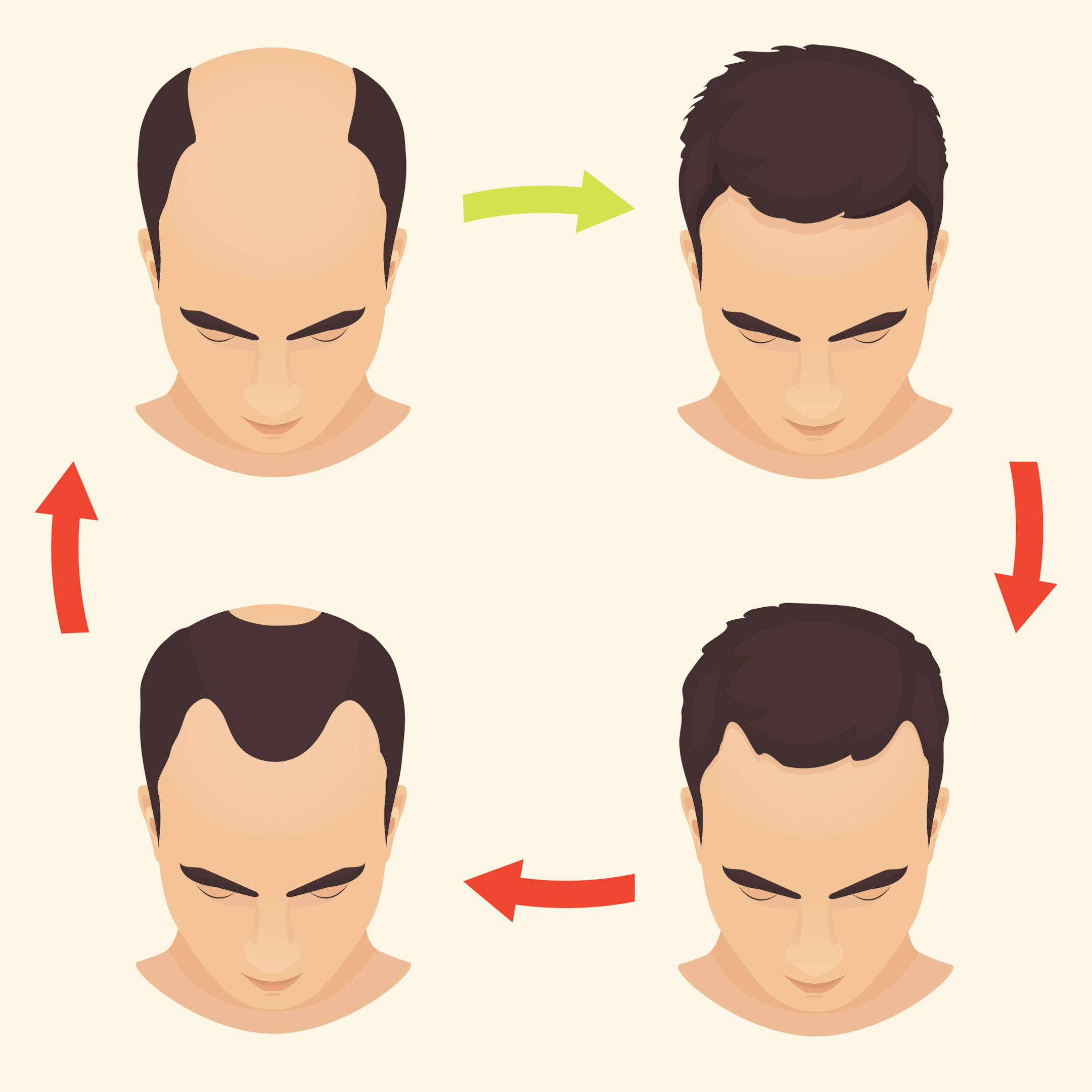 cartoon stages of hair loss