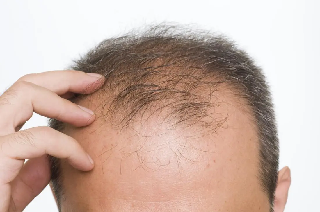 Man's hair loss