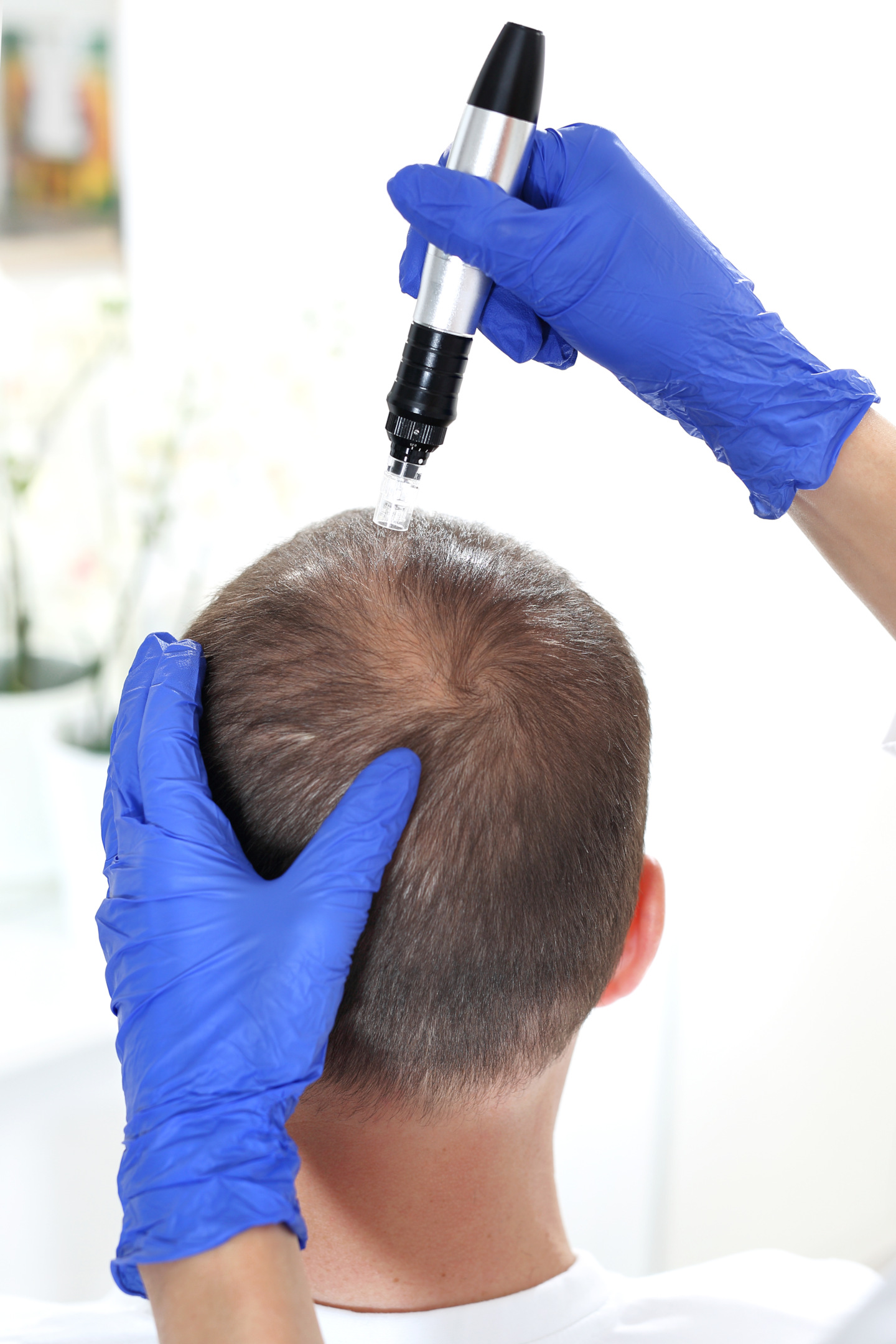 scalp microneedling