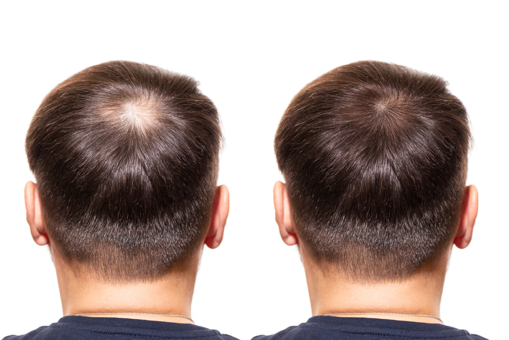 hair regrowth before and after 