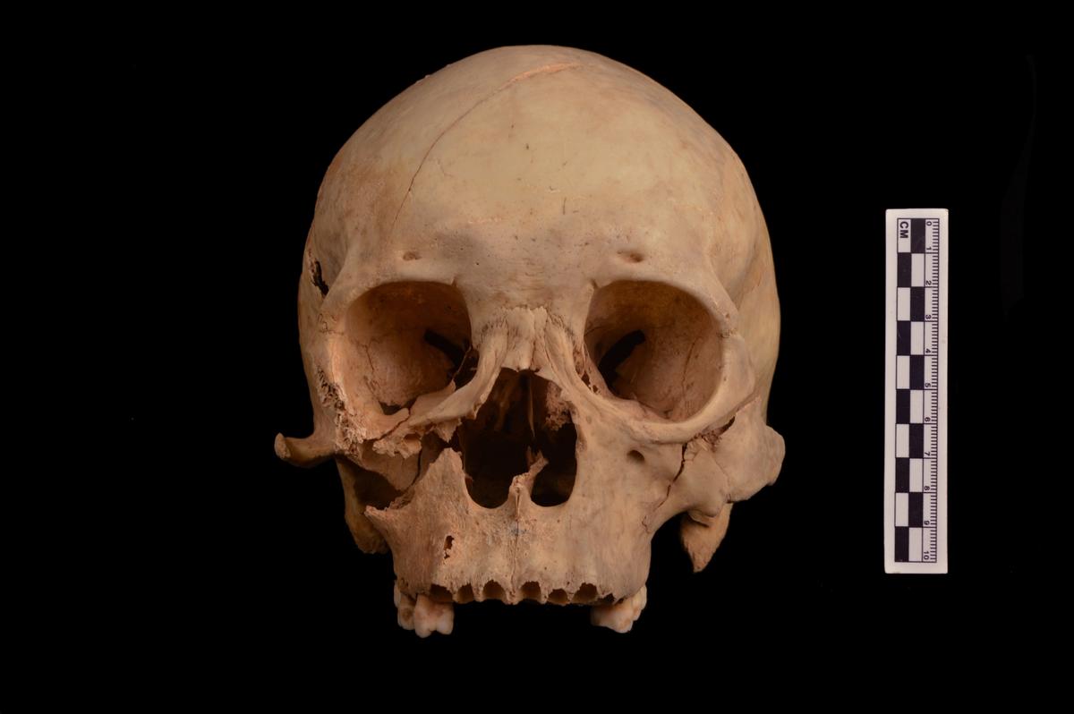 The skull of a young man showing signs of trauma, found in the Shiyanzi cemetery robbery shaft © Qian Wang
