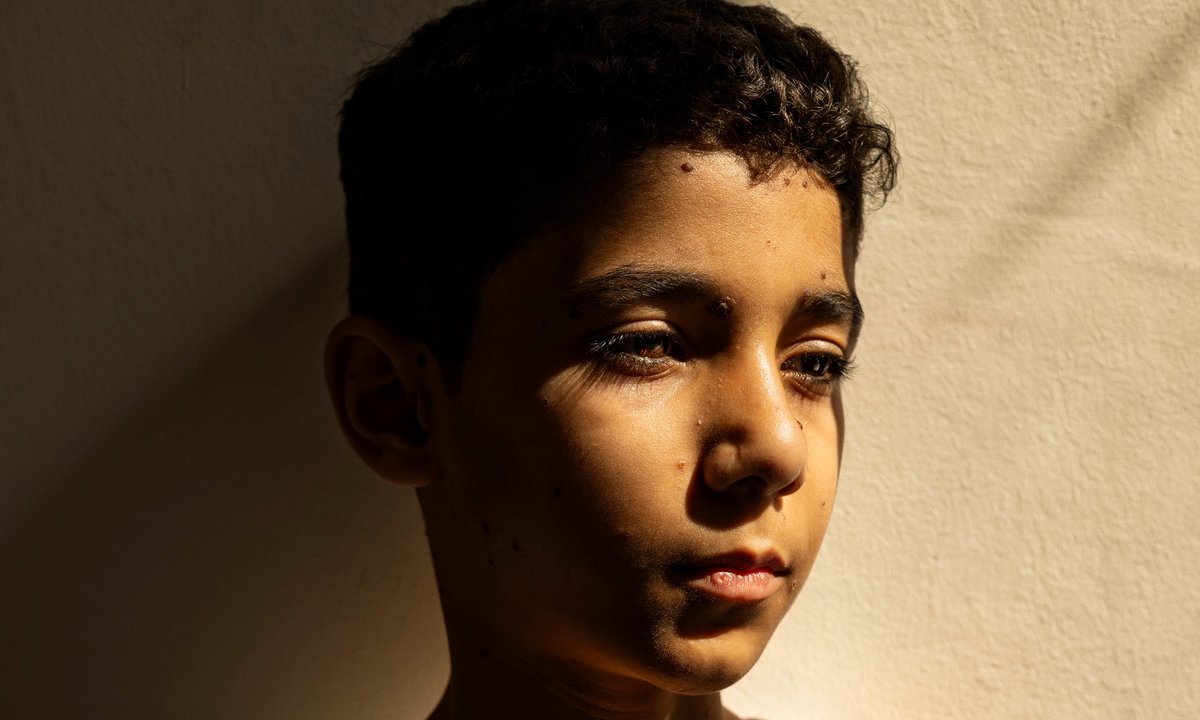 Palestinian photojournalist Samar Abu Elouf wins World Press Photo with image of young Gazan amputee
