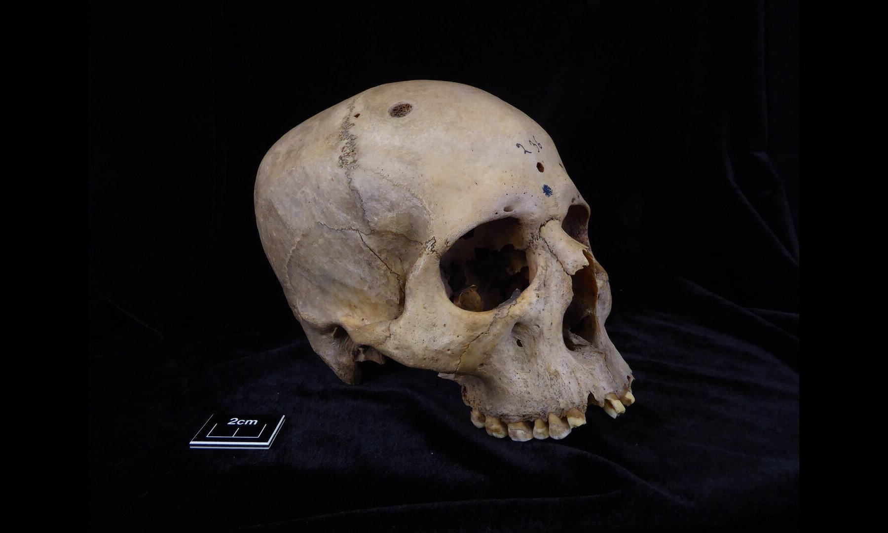 Ancient Egyptian skull shows possible signs of early cancer surgery - Vimarsana News