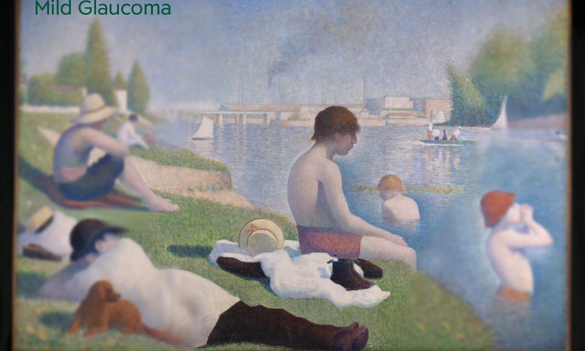 Caravaggio, Holbein and Botticelli through ‘the lens’ of glaucoma Caravaggio, Holbein and Botticelli through ‘the lens’ of glaucoma