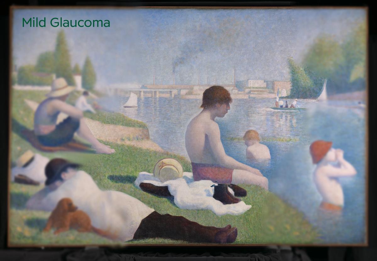 Bathers at Asnières (1884) by Georges Seurat (as seen by someone with mild glaucoma).
Courtesy Specsavers