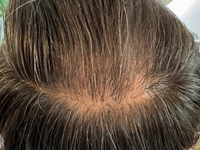 Hinterkopf mit mehr Haaren nach der Anwendung des ribogrow Hair Booster Tonic