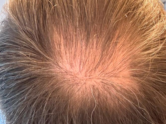 Kahler Hinterkopf vor der Anwendung des riborgrow Hair Booster Tonic